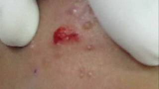 Treatment of Molluscum Contagiosumwmv [upl. by Corbie]