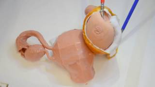 Timelapse of laparoscopic ovarian cyst removal using 3D printed models [upl. by Parthen]