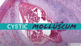 Molluscum Contagiosum cystic 5Minute Pathology Pearls [upl. by Lemmy26]