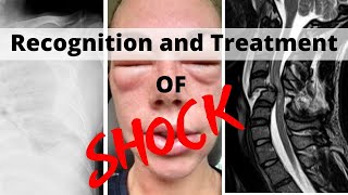 Recognition and Treatment of Shock [upl. by Tacye307]