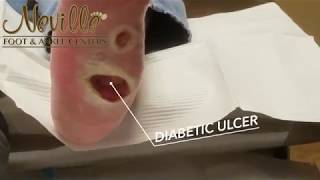 Diabetic Ulcer Wound Care PART 1 [upl. by Euqnimod]