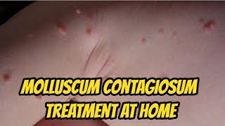 Molluscum contagiosum Treatment At Home [upl. by Nwadrebma617]