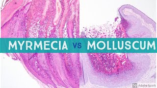 Molluscum vs Myrmecia Wart  Dermpath Lookalikes [upl. by Allare]