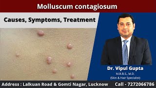 Molluscum contagiosum  Causes Symptoms Treatment [upl. by Aivatnwahs]