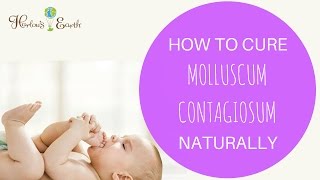 How To Cure Molluscum Contagiosum Naturally [upl. by Mast844]