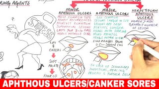 Aphthous Ulcers  Canker Sores  Pathophysiology Triggers Types amp Treatment [upl. by Nnayrb886]