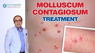 Molluscum Contagiosum Treatment  Dr Rohit Batra [upl. by Iahc]