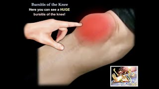 Prepatellar Bursitis Anterior knee pain and swelling [upl. by Corvin762]