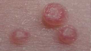 How to treat Molluscum Contagiosum [upl. by Hurlee]