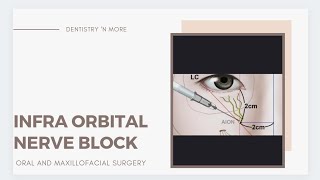 INFRA ORBITAL NERVE BLOCK [upl. by Braca]