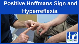 Positive Hoffmans Sign and Hyperreflexia [upl. by Beverlie]