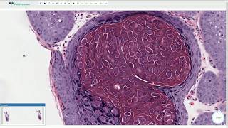 Molluscum Contagiosum  Histopathology [upl. by Chrysa180]