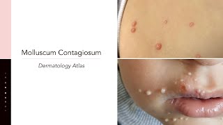 Molluscum Contagiosum [upl. by Leonardo538]