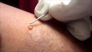 Removing H P Body From Molluscum Contagiosum [upl. by Uriia]