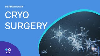 Cryo Surgery Procedure Freezing [upl. by Meerak242]