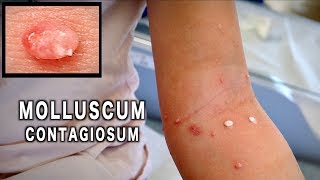 UNUSUAL MOLLUSCUM CONTAGIOSUM Treated with Cryotherapy  Dr Paul [upl. by Ladnyk]