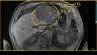 Giant Liver Hemangioma With Cystic Degeneration on MRI [upl. by Baryram]