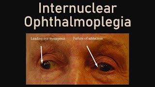 Internuclear Ophthalmoplegia [upl. by Alig]