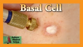 Basal Cell Cryotherapy Treatment  Auburn Medical Group [upl. by Anpas]